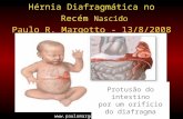 Hérnia Diafragmática no Recém Nascido Paulo R. Margotto - 13/8/2008 Protusão do intestino por um orifício do diafragma .