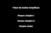 Fotos de lesões herpéticas Herpes simples I Herpes simples II Herpes zoster.