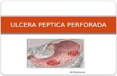 Ulcera peptica perforada
