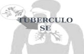 A tuberculose (TB) é uma doença infecciosa que afeta principalmente o parênquima pulmonar, ou seja, os alvéolos. E começa quando um indivíduo suscetível.