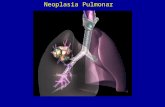Neoplasia Pulmonar. 1) Carcinoma de células escamosas 2) Carcinoma de células pequenas 3) Adenocarcinoma - Adeno Ca não bronquiolo alveolar - Adeno Ca.