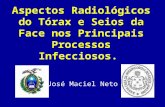 Aspectos Radiológicos do Tórax e Seios da Face nos Principais Processos Infecciosos. José Maciel Neto.