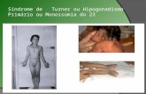 Síndrome de Turner ou Hipogonadismo Primário ou Monossomia do 23.