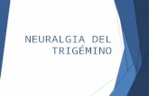 Neuralgia Del Trigémino