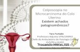 Colposcopia no Microcarcinoma do Colo Uterino Existem ... · PDF fileü ZT é de grande extensão e apresenta um conjunto diferente de ... DE PATOLOGIA VULVOVAGINAL Rio de Janeiro