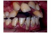 Anatomia do Periodonto · ANATOMIA DO PERIODONTO Divisão anátomo-funcional Periodonto de sustentação •Osso alveolar* •Cemento radicular •Ligamento periodontal