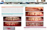 O TRATAMENTO DA HIPERSENSIBILIDADE DENTINÁRIA: …sobrape.com.br/anais/pdf/1056.pdf · A hipersensibilidade dentinária é definida como uma dor decorrente da exposição ... meio