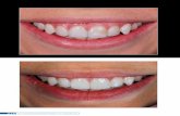* Doutora, Mestre e Especialista em Dentística pela UFSC ... · associação com a evolução dos sistemas adesivos e materiais cerâmicos, originou uma nova era odontológica, ...