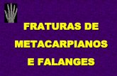 FRATURAS DE METACARPIANOS E FALANGES - …ortobook.com.br/wp-content/uploads/group-documents/14/1349043462... · Fratura da Cabeça dos Metacarpianos ... Fratura do Colo dos Metacarpianos