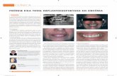 CLÍNICA - jornaldentistry.pt · prótese fixa total implantossuportada, encontra-se docu-mentada como sendo um dos marcos mais importantes na implantologia, uma ...