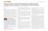 REABILITAÇÃO DE MAXILAR SUPERIOR EDÊNTULO COM ... · Este artigo descreve um caso clínico de reabilitação de ... e foram colocados 4 implantes cilíndricos de 3,3 mm ... com