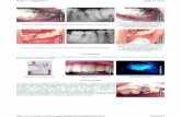 2011 - saudedireta.com.br · de granuloma , tratamento penetração desinfetante Dente 32, segundo paciente, apresenta ... contenção rígida (fio ortodôntico) O paciente apresenta