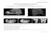 Nefroma mesoblástico congênito - apps.einstein.brapps.einstein.br/revista/arquivos/PDF/1495-Einsteinv7n4p529-31... · O estudo foi complementado com tomografia computadorizada multislice
