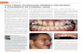 CLÍNICA - jornaldentistry.pt · desafiantes tanto para o médico dentista como para o téc - nico de prótese dentária. Recentemente, um desses casos ... O primeiro passo foi a
