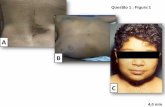 Questão 1 : Figura 1 - endocrino.org.br · Ao exame: nódulo palpável no LE, móvel, indolor e de consistência elástica. Não se evidenciou adenomegalia na cervical à palpação.