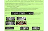 El papel del radiólogo en el diagnóstico del síndrome aórtico agudo · 2015-09-05 · Complicaciones: rotura del aneurisma, eventos tromboembólicos y compresión o erosión de