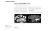 Ceruminous adenomaneurobarraconsult.com/files/Ceruminous Adenoma Arq.NeuroPsiq. 2011.pdf · Arq Neuropsiquiatr 2011;69(2-A):266 266 Images in neurology Ceruminous adenoma Péricles