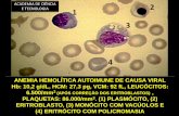 ANEMIA HEMOLÍTICA AUTOIMUNE DE CAUSA VIRAL Hb: 10,2 … · 2 4 3 3 3 2 2 academia de ciÊncia e tecnologia. infecÇÃo por citomegalovirus (virus da herpes) leucÓcitos: 11.000/mm3