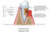 Patologia dinţilor Патологиязубов Pathology of teeth....Хронический фиброзный пульпит.(Окраска Г-Э).Обозначения: 1. Разрастание