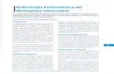 Radiocirugía Estereotáctica del IMeningioma Intracranealrepebis.upch.edu.pe/articulos/rev.peru.neurocir/v3n2/a4.pdf · Radiocirugía Estereotáctica del Meningioma Intracraneal