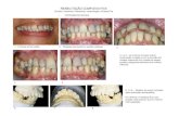 REABILITAÇÃO COMPLEXA FIXA · 2016-09-09 · REABILITAÇÃO COMPLEXA FIXA Oclusão, Ortodontia, Endodontia, Implantologia e Prótese Fixa 1 – Linha de sorriso média 2 - Projecção