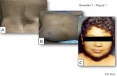Questão 1 : Figura 1 - SBP · 2017. 6. 6. · Questão 11 2,5 min Falo = 2,0 cm ; Abertura perineal única ; Saliências labioescrotais não fundidas Apenas gônada direita palpável