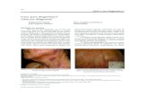 Caso para diagnóstico Case for diagnosis · F IGURA1: Lesões eritematosas com crosta hemática recobrindo as fístulas na região cervical esquerda F 2: Lesões liquenóides, anulares,