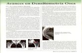 Avances en Densitometria Osea - spmedflix.com · Avances en Densitometria Osea Por: Dr. Carlos Jimenez Marchan La osteoporosis es una enfermedad del esqueleto que se caracteriza por
