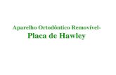 Aparelho Ortodôntico Removível- Placa de Hawley · 2020. 3. 31. · • Fonte de pressão (Ativa): compõem a parte ativa do aparelho a qual provoca o movimento dentário. • Sistema
