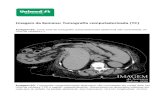 Imagem da Semana: Tomografia computadorizada (TC)...Análise da imagem Imagem 1: Corte axial de tomografia computadorizada abdominal não-contrastada, ao nível de L1. Presença de