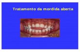 Tratamento da mordida aberta - Moro Ortodontia