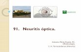 91. Neuritis óptica.
