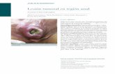 A tumor in the anal region - dermatolarg.org.ar